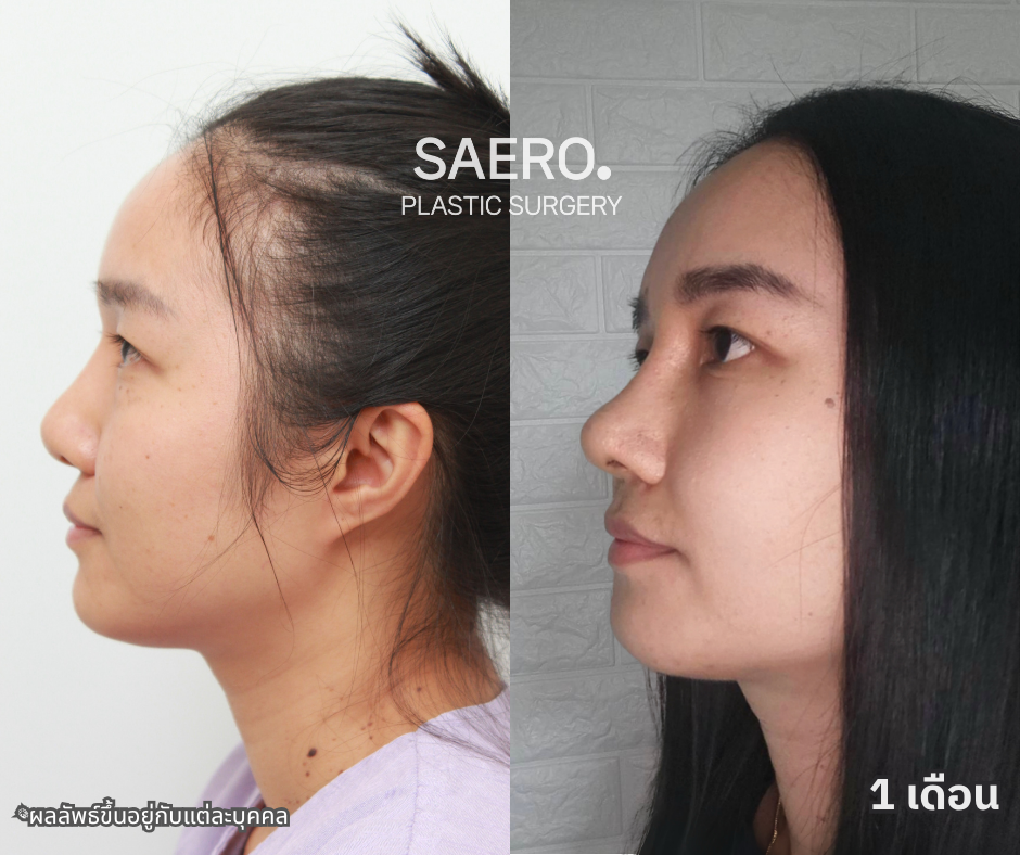 ศัลยกรรมแก้จมูก-เซมิ โอเพ่น มุม 45 องศา