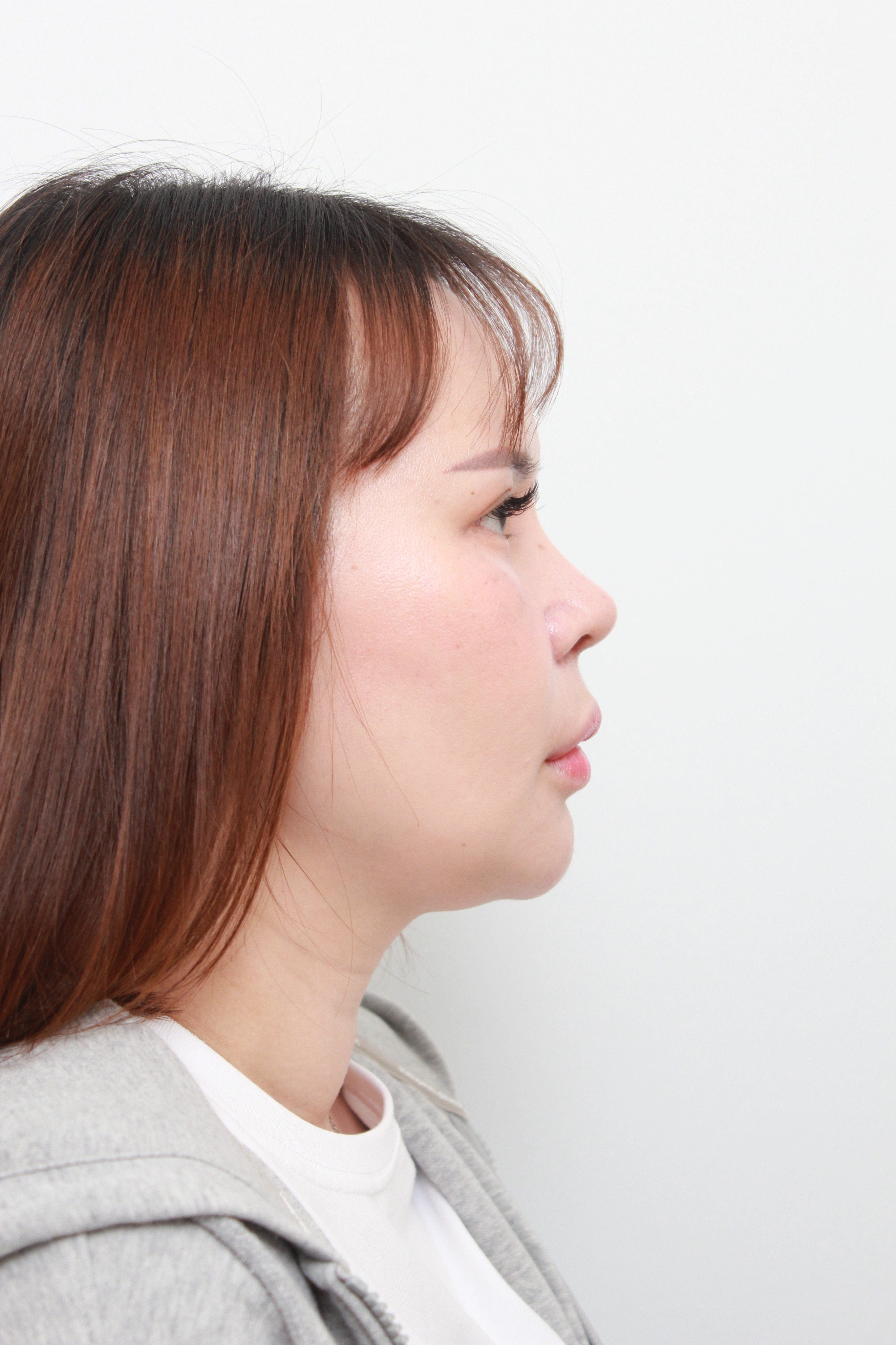ศัลยกรรมแก้จมูก-โอเพ่น ด้านข้าง