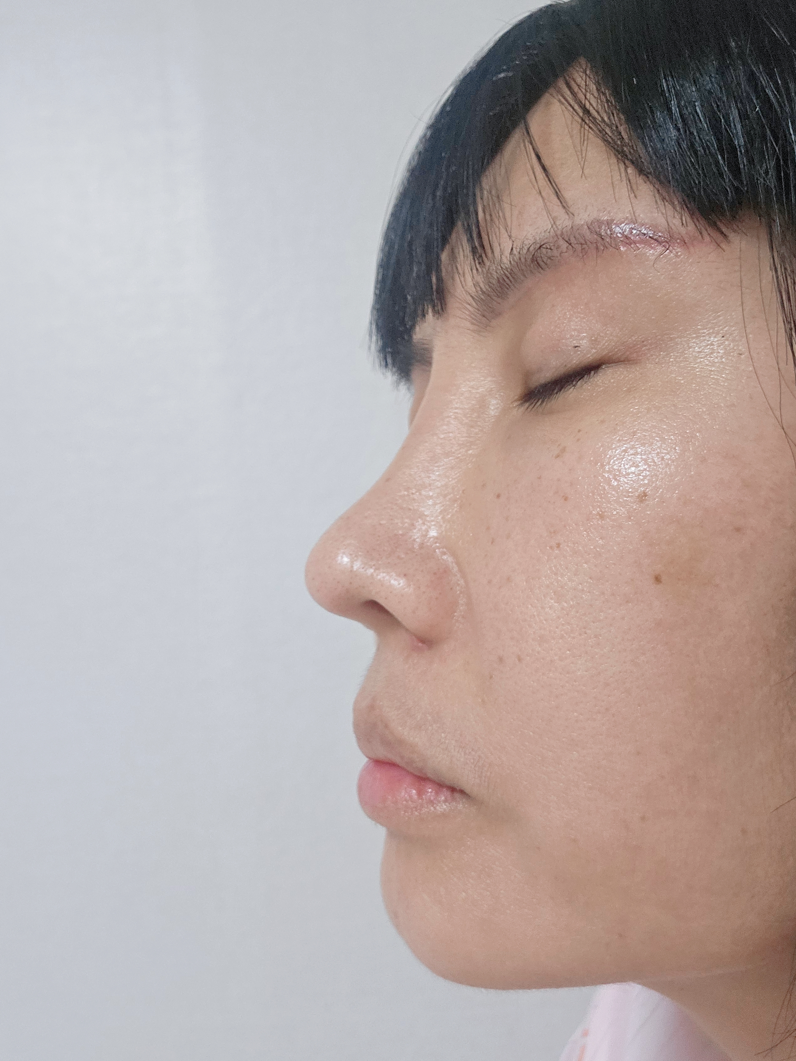 ศัลยกรรมแก้จมูก-เทคนิคไร้รอยแผล ด้านข้าง