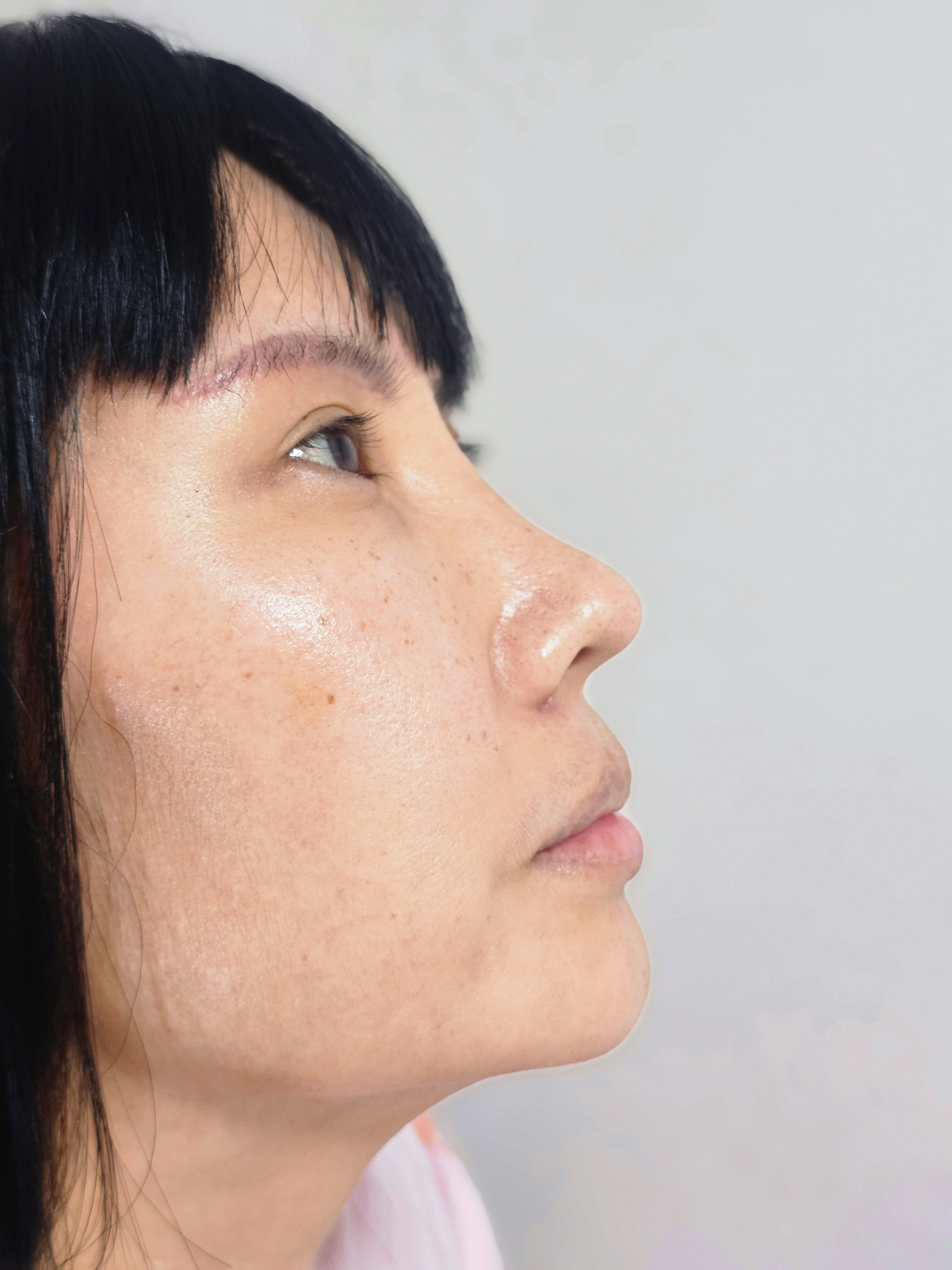 ศัลยกรรมแก้จมูก-เทคนิคไร้รอยแผล มุม 45 องศา